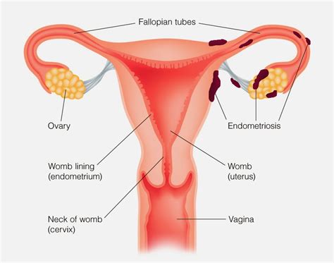 endometriosis what is it and how does it affect fertility virginia center for reproductive