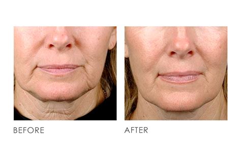 Ultherapy Before After