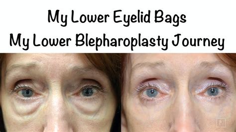 My Lower Eyelid Bags My Lower Blepharoplasty Journeyrecovery Story