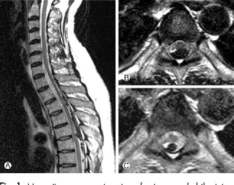 Figure 1 From Long Term Sequela Of Intradural Extramedullary Tuberculoma In The Thoracic Dorsal