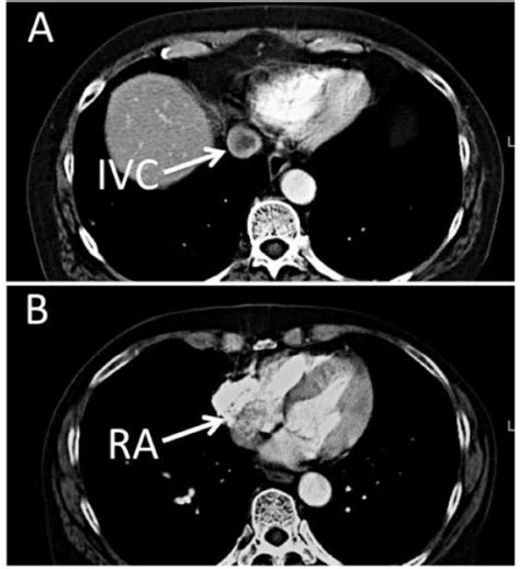 Visualization Of The Ivc Tumor Using Contrast Enhanced Open I