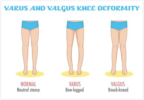 Your Childs Knocked Knees Everything You Need To Know