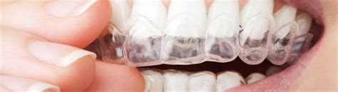 Dentes Alinhados Sem Aparelho Fixo Odontomania