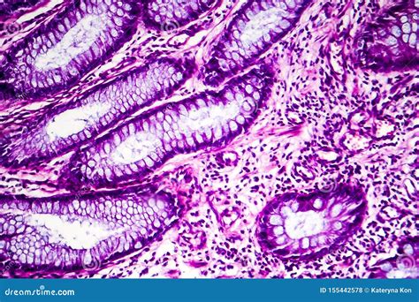 Adenocarcinoma Intestinal Bien Distinguida Microgr Fo Ligero Foto De
