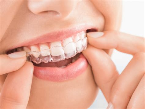 Transforming Smiles And Lifestyles A Comprehensive Guide To Invisalign