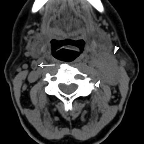 Evaluation Of Cervical Lymph Nodes In Head And Neck Cancer With Ct And
