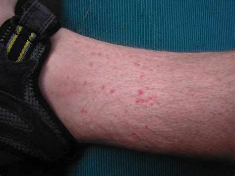 Flea Allergy Dermatitis On Humans