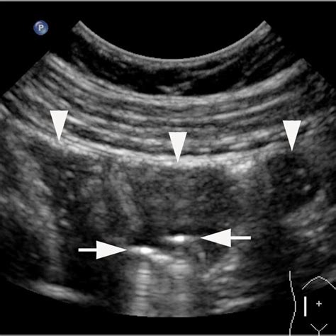 Ultrasound Examination Of Patient In Figure 5 Showing Two Abutting