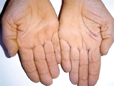 Tripe Palms Keratoderma On The Palms Of The Same Patient Download