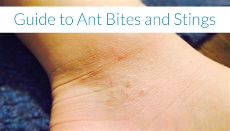 Your Guide To Ant Bites And Stings