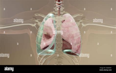 3d Illustration Of Pneumothorax Normal Lung Versus Collapsed Symptoms