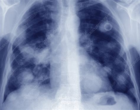 Secondary Lung Cancer Ct Scan Stock Image C0402227 Science