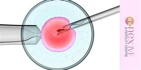 Intracytoplasmic Sperm Injection Icsi Top Fertility Clinic In Patna