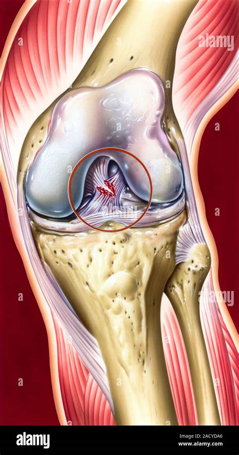 Knee Ligament Strain Hot Sex Picture