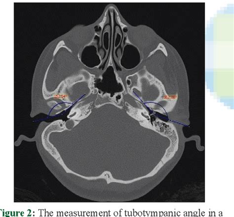 Figure 1 From The Evaluation Of The Angles Of Eustachian Tubes In The Patients With Chronic