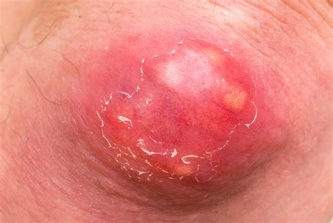 Water Blister On Thigh Hot Sex Picture