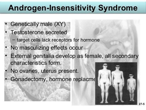 Turner Syndrome As Related To Androgen Insensitivity Syndrome Pictures