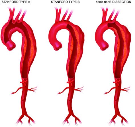 Definitions Of Aortic Dissections Printed With Permission From V C