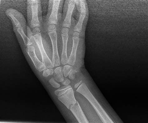 Greenstick Fracture X Ray