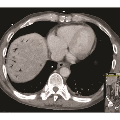 Ct Scan Of The Abdomen Showing Resolution Of The Portal Venous Gas