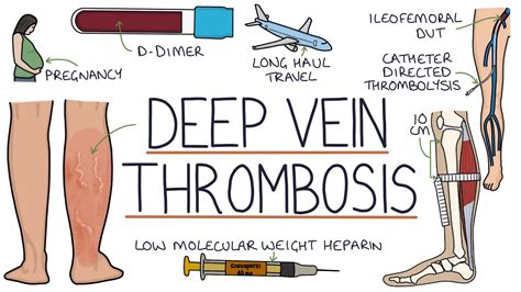 Deep Vein Thrombosis Causes Symptoms And Treatment