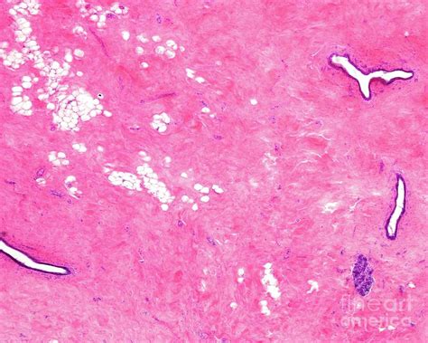 Breast Fibrosis Photograph By Jose Calvo Science Photo Library Pixels