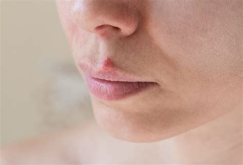 Herpes labial qué es y por qué aparece