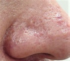 【鼻のニキビ跡・凹凸】複合的治療の経過 | Drこじまの美容皮膚科・美容外科ブログ