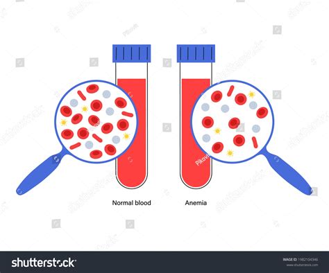 Normal Blood Specimen Anemia Disease Human Stock Vector Royalty Free