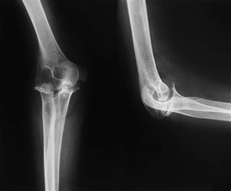 How Rheumatoid Arthritis Affects Each Part Of The Body