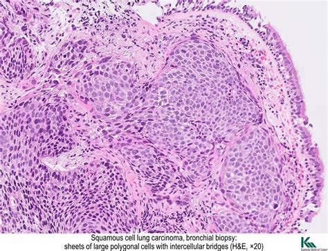 Pathology Outlines Squamous Cell Carcinoma Scc