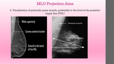 Mammography Positioning Technique For Mlo View