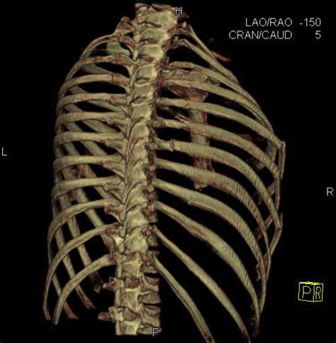 Rib Fracture Fixation Critical Care Clinics