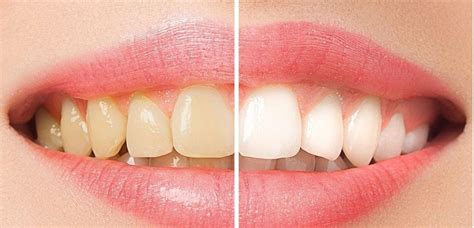 Teeth Whitening Steps To A Whiter And Brighter Smile Teeth