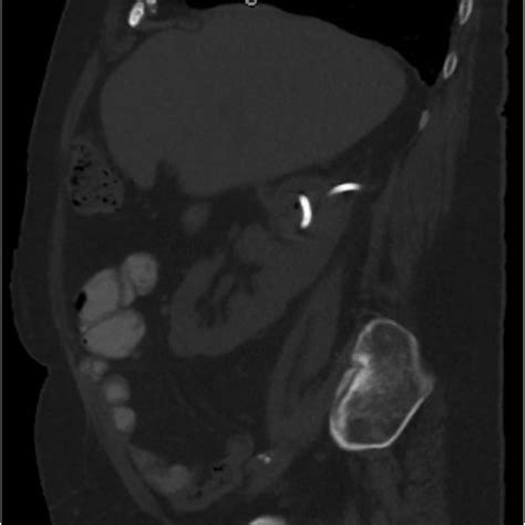 Ct Scan Showing 5cm Right Upper Pole And 3cm Right Mid Pole Renal