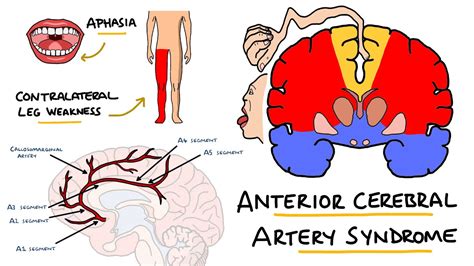 Anterior Cerebral Artery Stroke Syndrome ACA Stroke Syndrome Stroke Syndromes YouTube