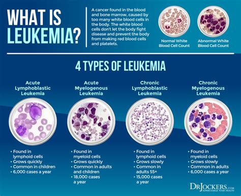 Leukemia Information