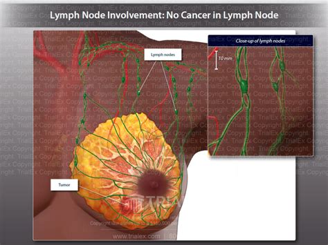 Lymph Node Involvement No Cancer In Lymph Node Trial Exhibits