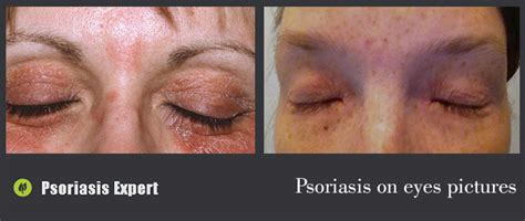 Psoriasis On Eyes Pictures Psoriasis Expert