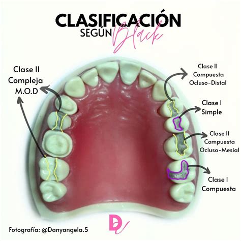 ⭐cavidades Segun Black Odontología Anatomía Dental Salud Dental