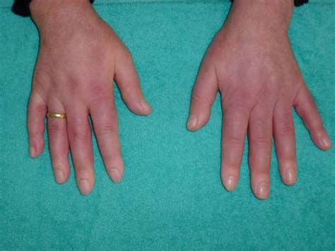 Le mani che cambiano colore possono essere sintomo di una pericolosa patologia ecco cos è la