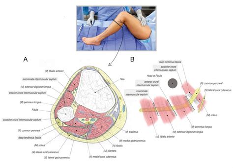 Common Peroneal Nerve Release At The Fibular Head Surgical Education