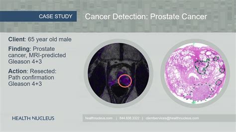 Prostate Cancer Detection YouTube