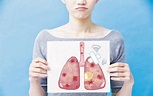 新冠遺「磨砂玻璃肺」 運動乏力 胸肺物理治療 掃走氣喘苦 - 20200406 - 副刊 - 每日明報 - 明報新聞網
