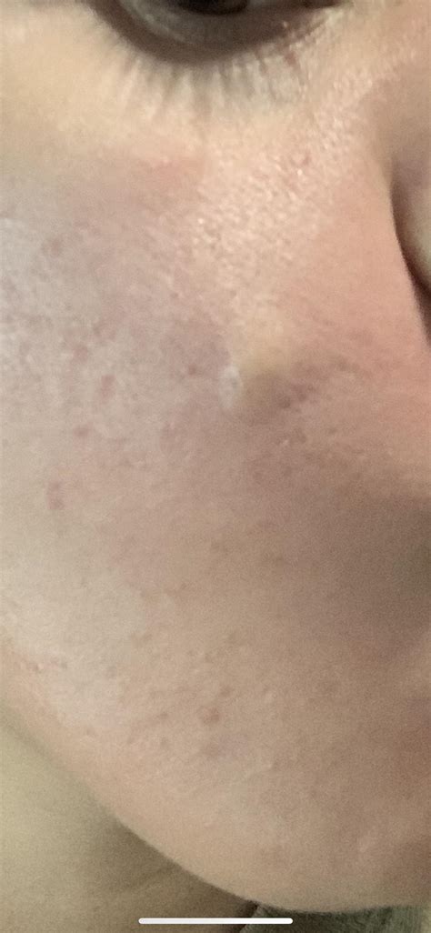 What Is This I Have Had This Bump Under My Skin For A Few Years Now