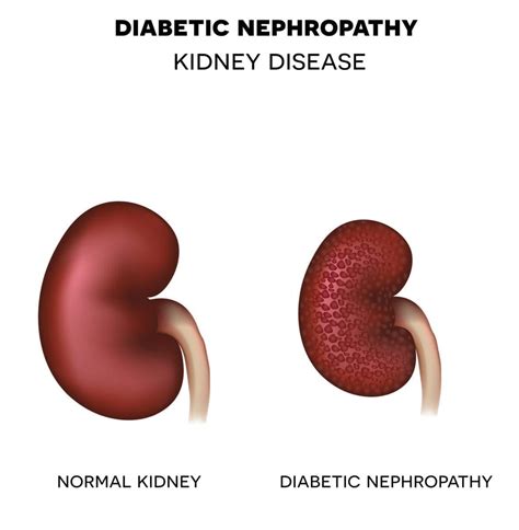 Nephropathy Diabetes