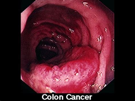 The earlier colorectal cancer can be found, the more likely it can be successfully treated. Symptoms of Colon Colorectal Cancer in Men & Women - YouTube