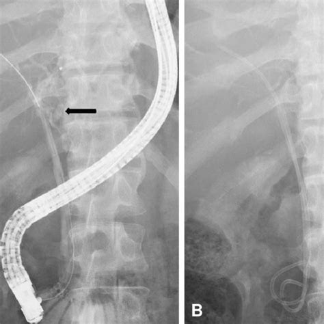 The First Ercp Showing Bile Leak At The Confluence Of The Left And