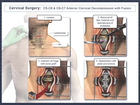 Cervical Surgery C5 6 C6 7 Anterior Cervical Decompression With
