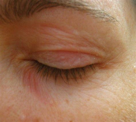 Patch Dry Red Skin Under Eye Clevertap